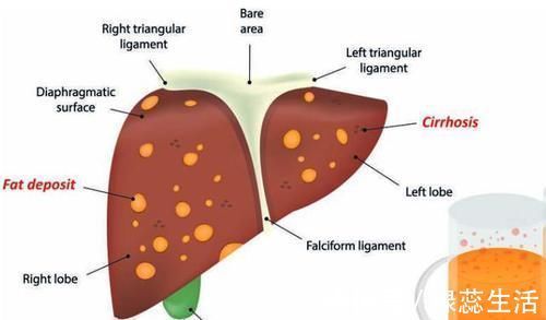 消化道出血|劝告:长期喝酒,若身体出现这4个信号,最好别再喝了