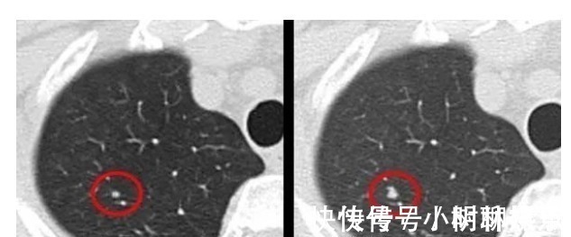 良性|结节、息肉、囊肿、增生哪个最可能癌变这么多年疑惑终于解开了