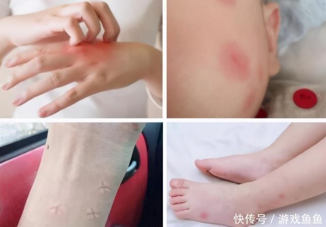 花露水|宝宝被蚊子咬成“大耳朵图图”,又疼又痒还留疤,怎么处理最好?