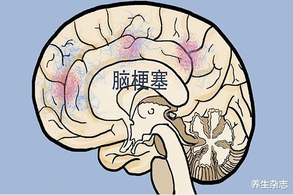 脑梗塞|脑梗的＂祸根＂不仅是肉，4种常见素食，常吃堪比＂喝油＂，也该进＂黑名单＂