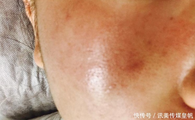 黑头|鸡蛋清能去黑头?医生提醒:2招轻松搞定草莓鼻烦恼