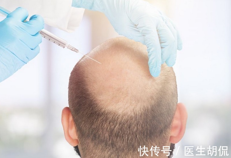 毛发 一个植发至少上万元?想要保住头发和钱包,别忘了做好4件事