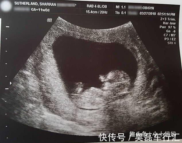 月月花|女子流产后,将14周“孩子”放进冰箱并分享,照片中孩子仅10厘米