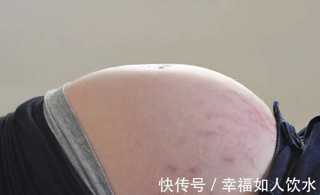 肚子|同是孕妇有人不长妊娠纹?有四个特征的孕妈不会被妊娠纹困扰
