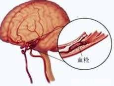 脑血管堵塞的前兆是什么专家说这3个前兆没有引起大家重视!