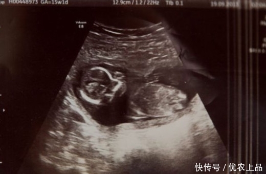 胞胎姐妹被妈妈用药物流掉,她却在母亲腹中安稳存活