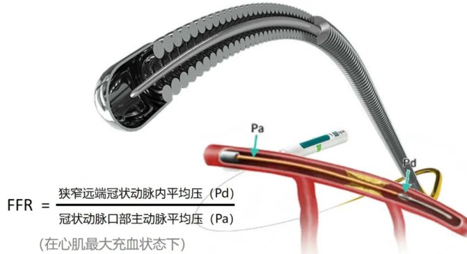 ct|【健哥说心脏】新出的CT-FFR技术，有用吗？
