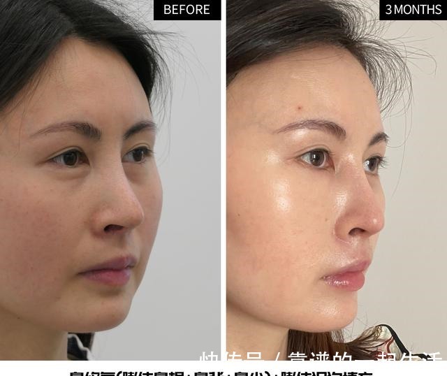 黑眼圈 求美者很想撤回的照片,真实记录泪沟、鼻修复术后3个月效果变化!