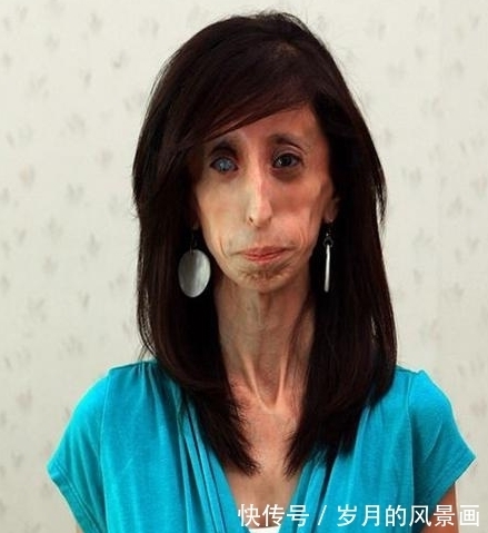 纪录|曾破吉尼斯最瘦纪录的骷髅女孩，只有27公斤，如今成励志女孩