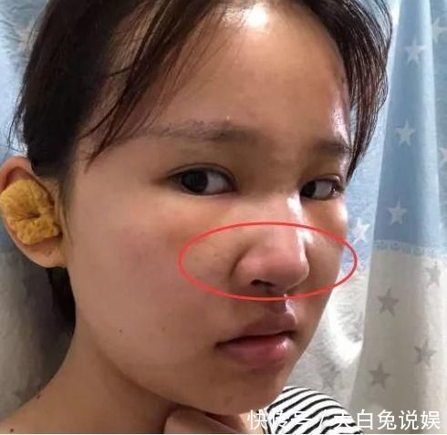 慢性|这3种动作等于“慢性毁鼻”,初中生若不当回事,早晚会越来越丑
