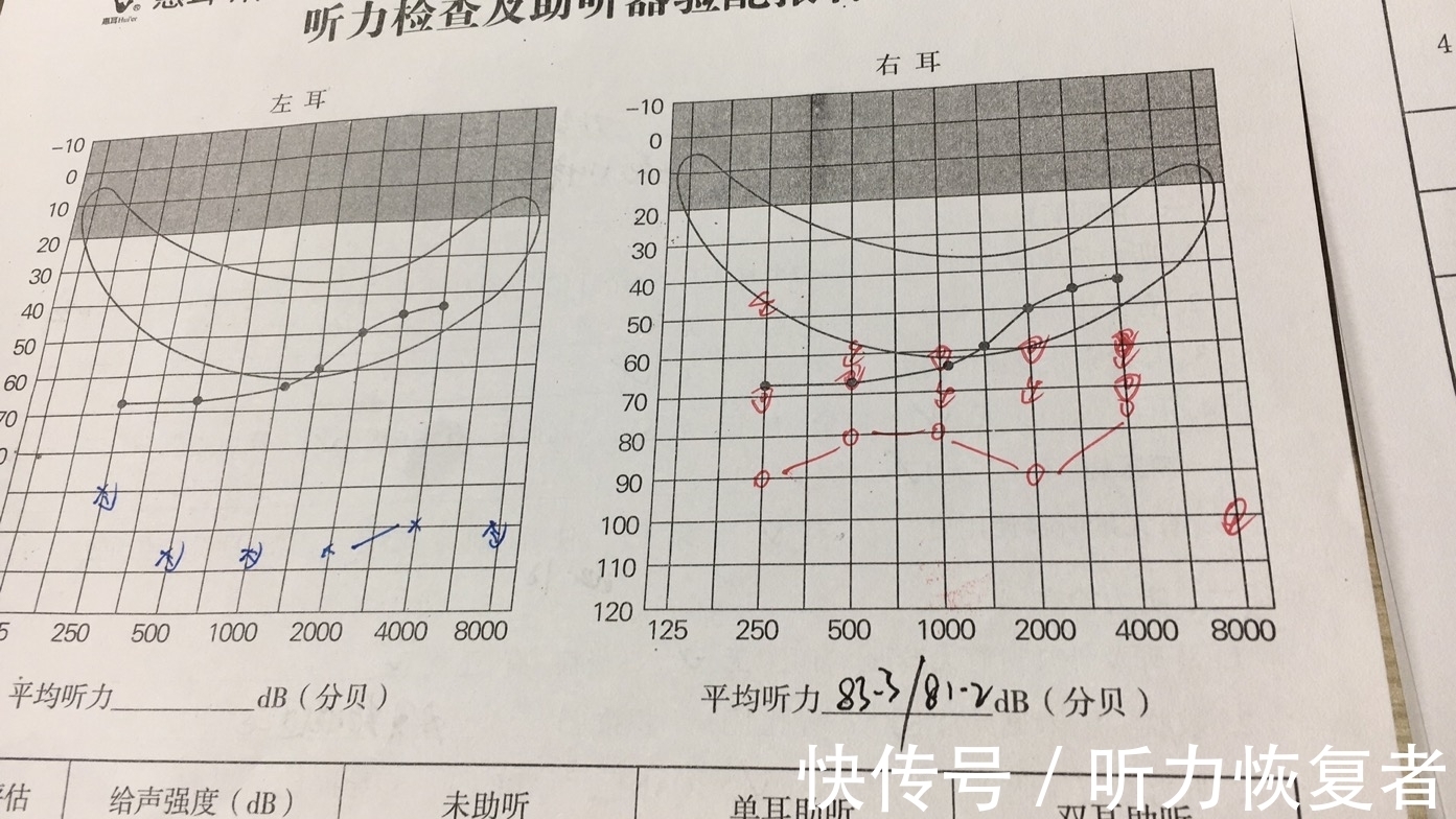 听力|聋哑人佩戴助听器的案例！