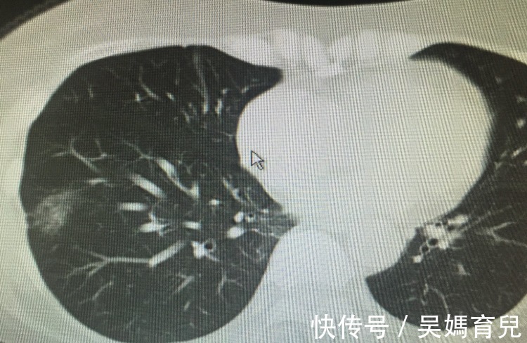 切除|体检结果显示有肺结节,严重吗?确诊肺结节,要马上切除吗?