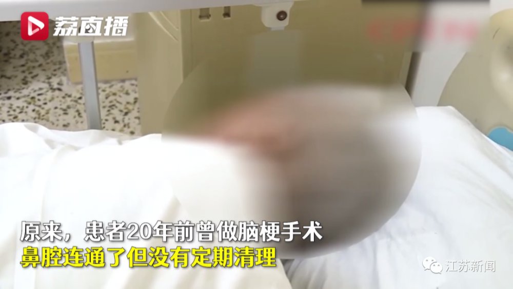 鼻子|八旬大爷鼻子发痒,医生竟从里面取出36条蛆