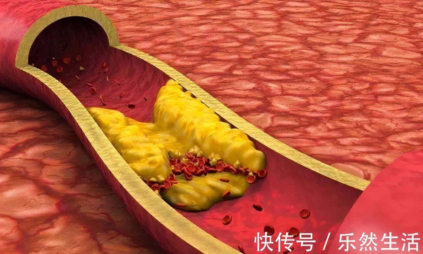 低密度脂蛋白胆固醇|颈动脉斑块一定会导致脑中风吗?一文带你读懂
