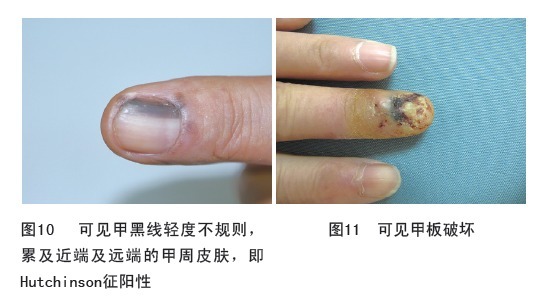 医生|指甲上有黑线,可能是最恶的癌症,医生教你怎么办