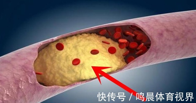 血压偏高|比油盐还伤血管,世卫组织已呼吁停止食用,血压偏高尽量注意