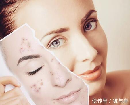 长痘留痘印,大部分与这几点有关!你一定也在其中