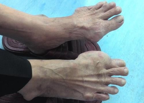 海鲜|海鲜是痛风的“发物”？尿酸高的人，“4鱼1豆”要少碰