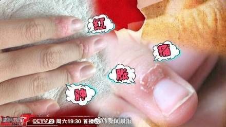 骨髓炎|提醒！手撕倒刺后果很严重！或致败血症、骨髓炎…