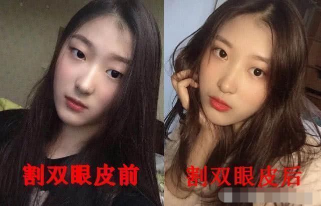 差距|割双眼皮前VS割双眼皮后,看见差距,眼睛变好看了但灵魂没了