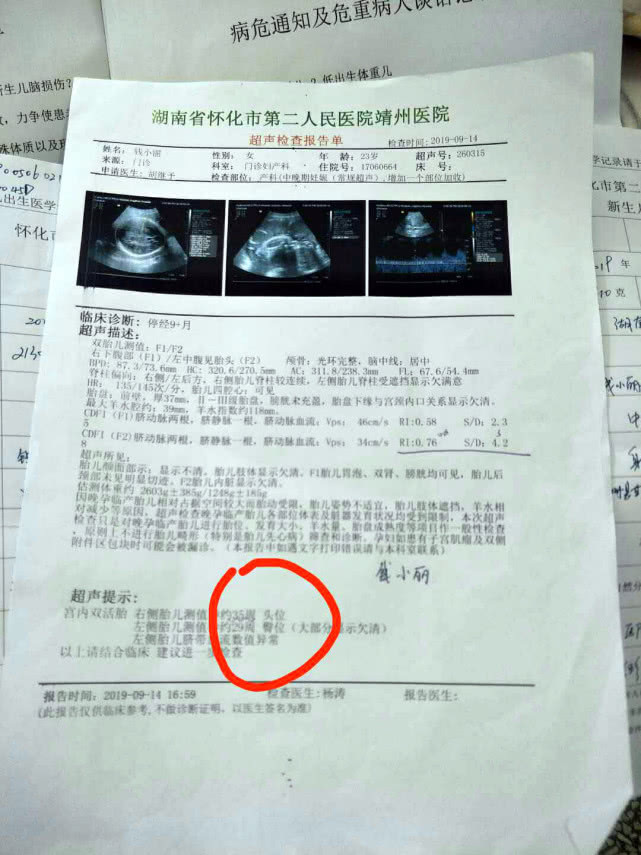 姚甜甜|早产双胞胎姐妹遭遇罕见病,出生时不足两斤,腿还没爸爸手指粗