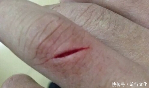 长期吃阿司匹林的人,要留意身上的三个变化,早点了解一下