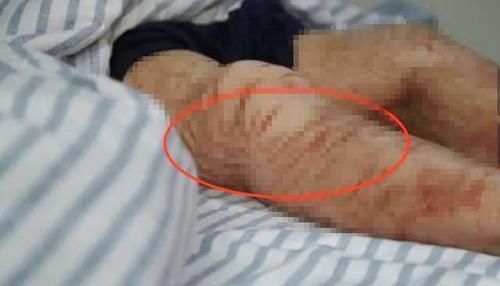 治疗|男孩染病4年皮肤成“豹纹”，治疗费超200万，向父母央求：割了吧
