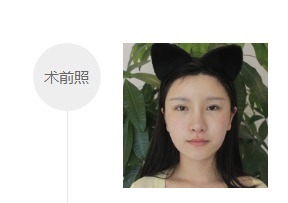 开眼角前后对比照效果图67天记录日记-焦作完美俪人案例