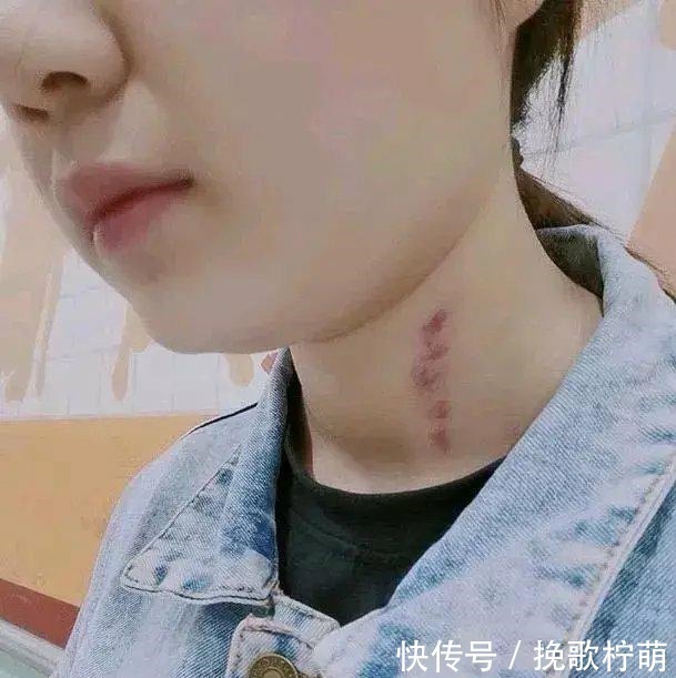 草莓印|15岁女儿脖子被“种草莓”,试纸检测发现怀孕,妈妈懊悔不已!