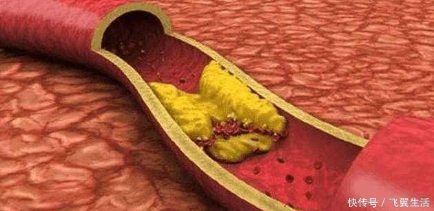 维生素p|血栓碰上“天敌”了! 常吃让你血管通畅, 血压血脂也正常了