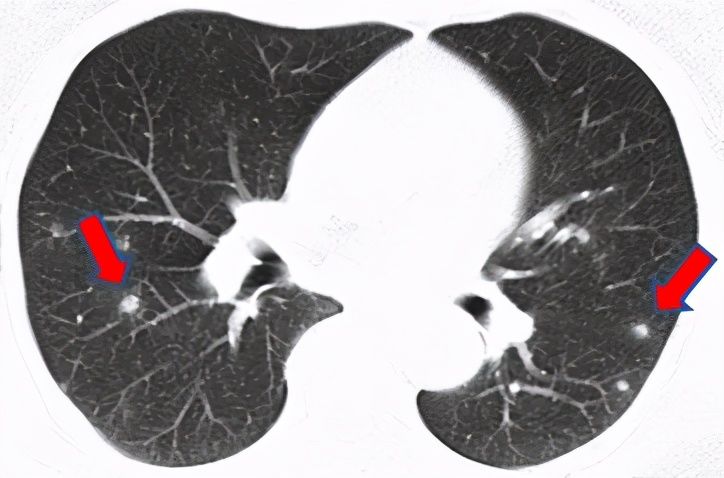 结节|刀下“留肺”!容易误认为癌性“肺结节”的8种感染