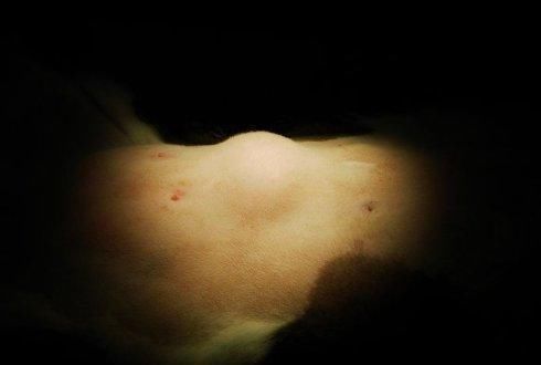 脂肪瘤|治“脂肪瘤”的小方子来了偷学来的险招,治疙瘩不痛、不痒