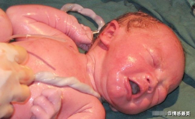 晓雪|怀孕几个月容易脐带绕颈? 牢记这些症状, 孕妈别疏忽