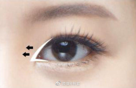 内眼角开太大了怎么办？是缝合好还是皮瓣转移修复好？