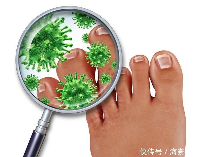 脚底|脚气一犯又臭又痒，厨房这2物专克脚气，每天用1点彻底解决脚气