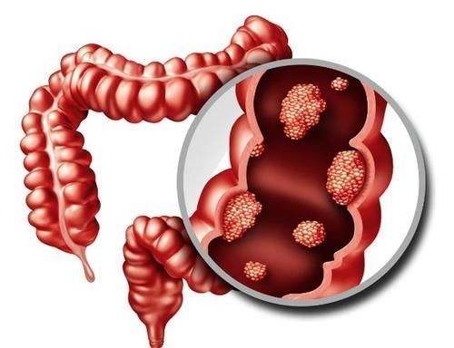 会长长|肠息肉会不会恶变为肠癌?关于肠息肉,这些问题你知道吗?