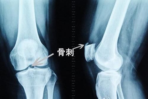 手術治療|腳后跟疼是怎么回事？或已暴露了4個問題，不要覺得忍一忍就好