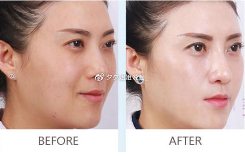 自体脂肪鼻唇沟填充的禁忌，自体脂肪鼻唇沟填充的优点有哪些？