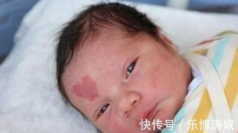 胎记|怀孕后的几件事一定要避免,为了孩子以后的容貌,再喜欢也要克制