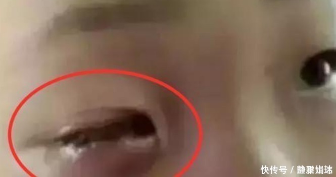 眼睛|8岁男孩20分钟眼睛被“熔化”,这种东西你家也有,父母要小心