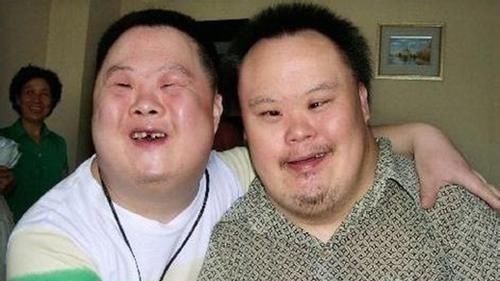 血清标志物|为什么唐氏综合征的人都长着“同一张脸”?唐氏综合征到底是啥?