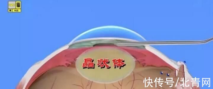 白内障|老花眼突然恢复 可能是白内障早期