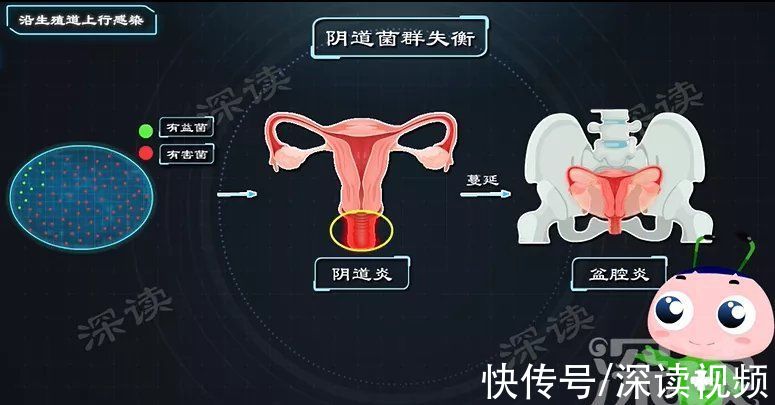 病原體|性生活過頻、人流手術會引發盆腔炎？生活中哪些事易招惹盆腔炎？