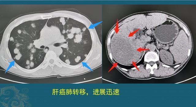 生存期|多数人得了癌症后，为何有人几个月就离世有人却非常长寿