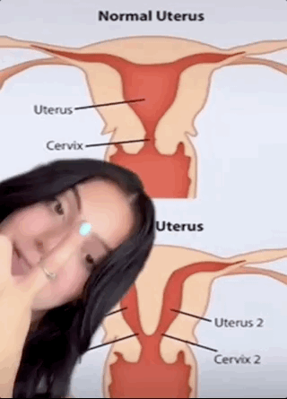 子宫|18岁少女有两个子宫?一月流两次血