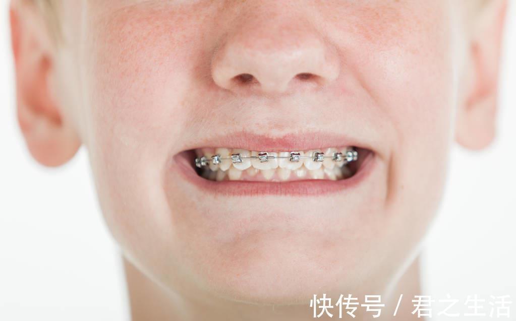 矫治|儿童做牙齿矫正三个最佳时间:家长要牢记,矫治越早干预效果越好