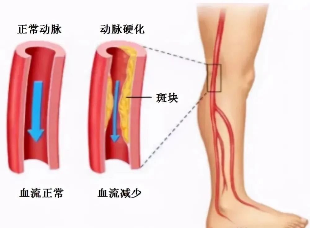 闭塞|【健康新生活】腿梗是个什么“梗”？