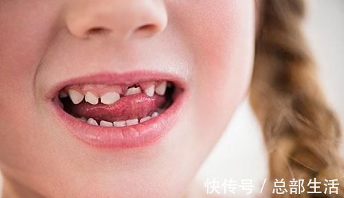 牙科医生|15岁男孩长出“尖牙”,妈妈亲手摸过后吐槽:养了个“吸血鬼”