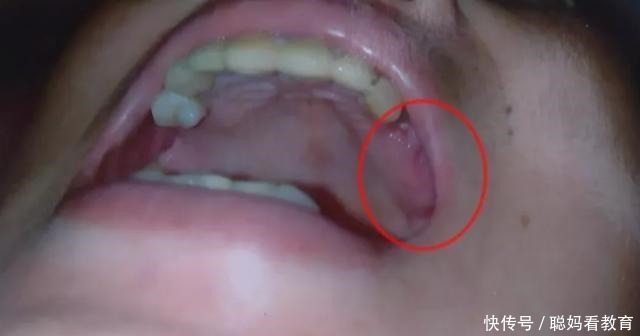 提前|打了4针麻药后,3颗真牙被拔掉了女子怒曝光没提前告知!