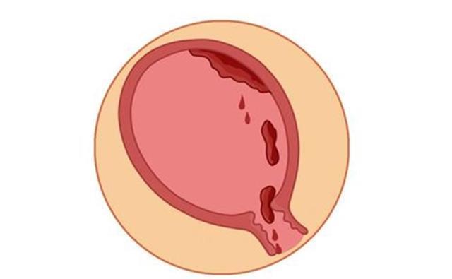 剖腹产|剖腹产后,产妇要做好的五件事,否则之后的月子就白坐了